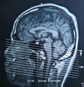 Brain MRI scan showing traumatic brain injury